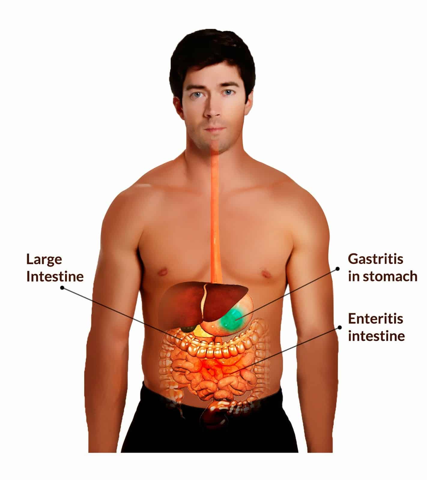 Dr Sherazi: Gastroenteritis