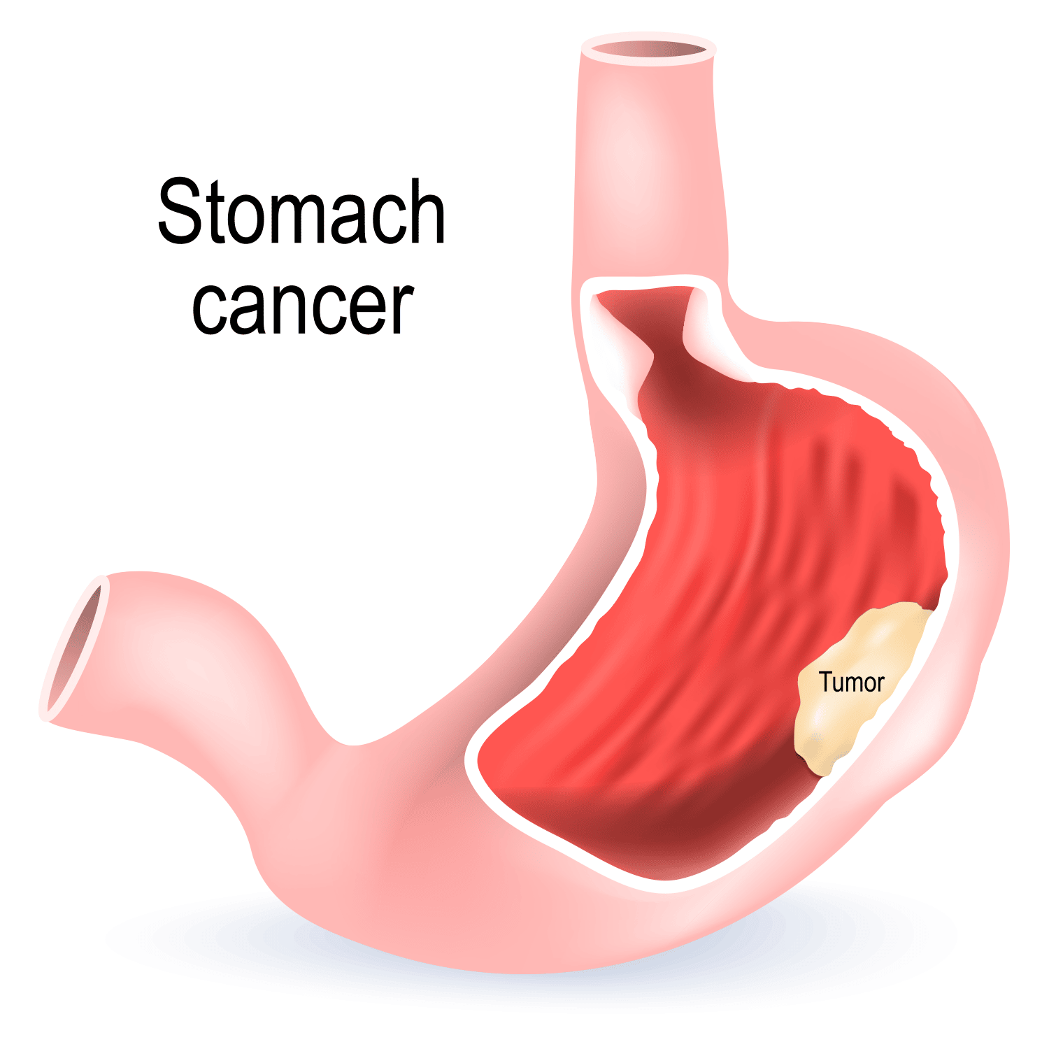 are-all-stomach-tumors-cancerous-stomachguide