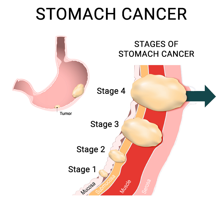 Stomach Cancer can be treated with the right help! Call NWMC now.