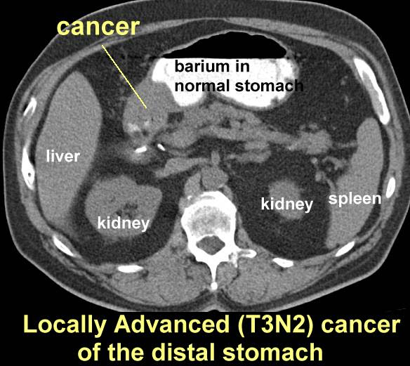 Stomach Cancer On Ct Scan