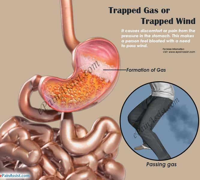 Why Does Gas Get Trapped In Your Stomach